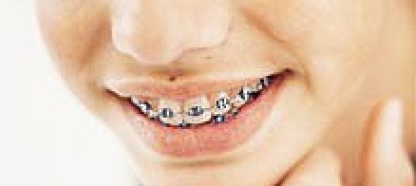 A QUI S’ADRESSE L’ORTHODONTIE ? - DR BODIN, DENTISTE A ANTIBES